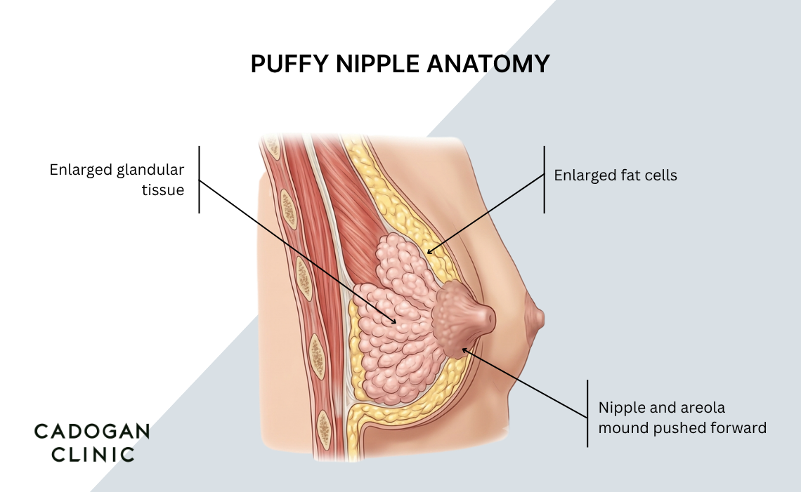 A diagram showing the anatomy of puffy nipples